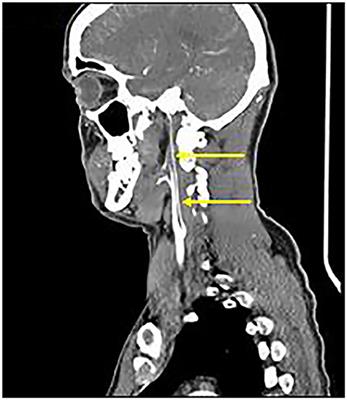 Extracranial and Intracranial Vasculopathy With “Moyamoya Phenomenon” in Association With Alagille Syndrome